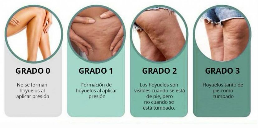 Tratamientos anti celulitis, tratamientos celulitis. Vitacura, Santiago